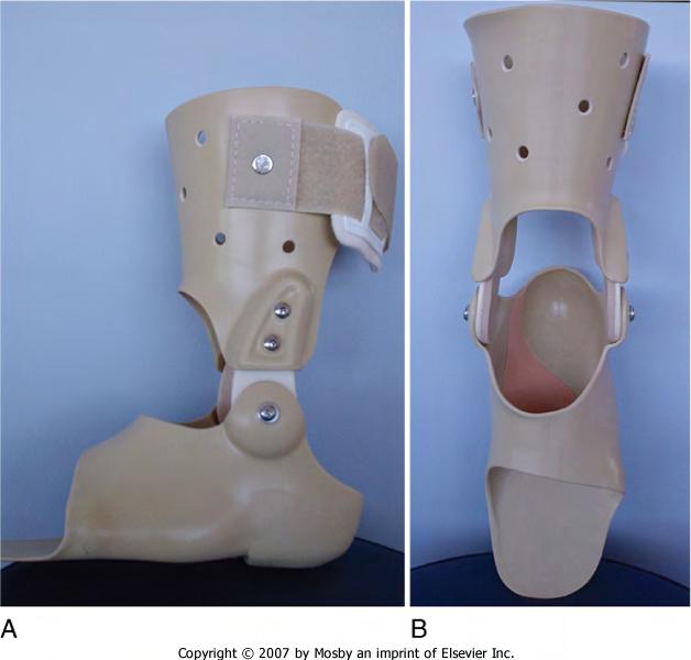 Verkregen degeneratieve platvoet - conservatieve behandeling - Enkel-voet brace (Arizona AFO) Alvarez