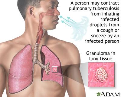 1. Inleiding Voldoende informatie krijgen over tuberculose is belangrijk. Wij raden u dan ook ten zeerste aan deze folder grondig door te nemen.