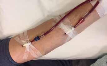 10 / Arterio-veneuze fistel Om te kunnen dialyseren, moet er een toegang zijn tot de bloedbaan.