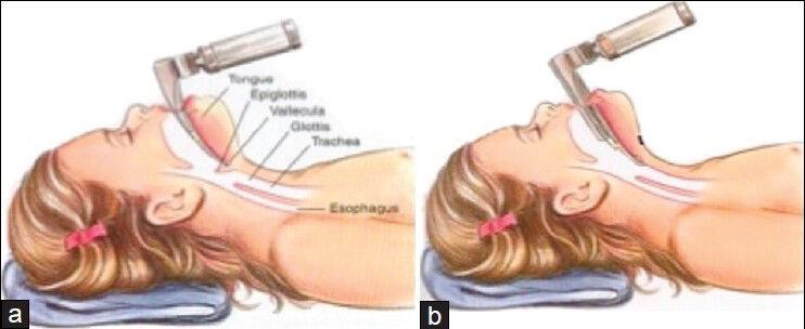 TRAUMA Plan B C-Spine Protection