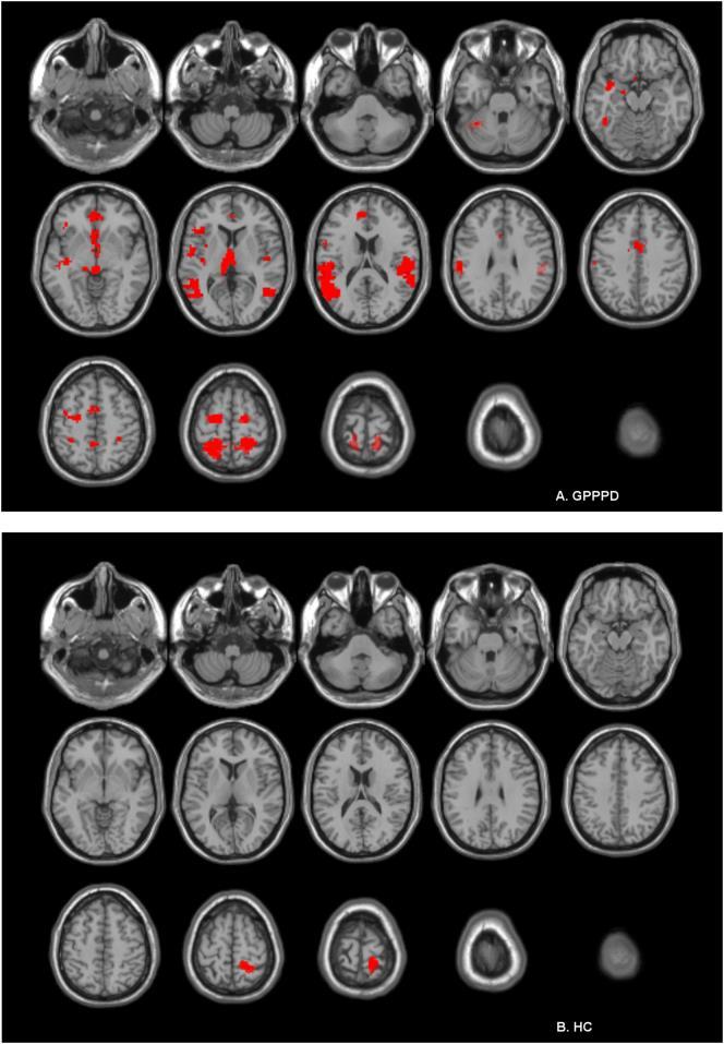 STUDIE PAZMANY (2017): ACTIVATIE HERSENGEBIEDEN BIJ GPPPD BIJ ANTICIPATIE OP PIJN Hersenreacties gedurende