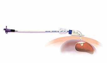 Hoofdstuk 4 - Verzorgen PEG-sonde In de verzorging van de sonde via de buikwand is een onderscheid gemaakt in de volgende aspecten: fistelvorming na plaatsing bij alle door de buikwand aangebrachte