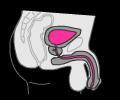 Blaaskatheter via urethra