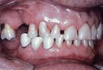a b c Afb. 2. Een extreem verkorte tandboog heeft bij deze oudere geleid tot minimale functies van het occlusiesysteem die wel als voldoende worden ervaren.