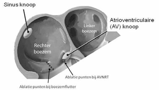 AVRT Tot de snelle hrtritmes uit de kmer behoren: Kmertchycrdieën (ventrikel tchycrdie/vt): dit is een snel regelmtig ritme tussen 120 en 250 slgen per minuut die in de kmers ontstt.