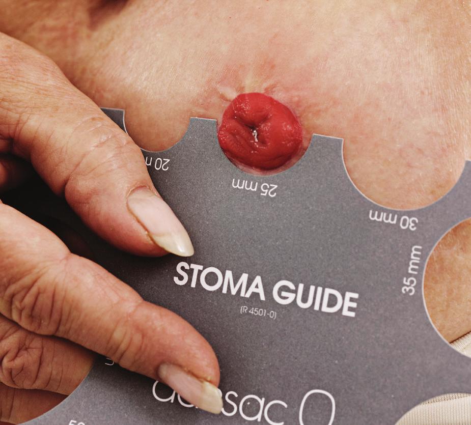 Verzorging en materiaal Stap 6: inspecteer de stoma en pas de plaat aan indien nodig Het is belangrijk om regelmatig uw stoma en de peristomale huid te inspecteren (een