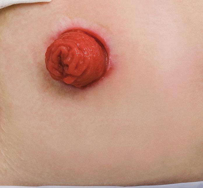 Net na de ingreep is de stoma vaak licht gezwollen. Pas na de eerste 6 tot 8 weken na de ingreep zal de stoma zijn definitieve grootte krijgen.