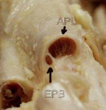 4. Tendinitiden Anatomische variatie extra septum in het 1e dors. ext. compartiment bij 40% (kadaverstudies tussen 24 en 76%) Ossale afwijking Proc.