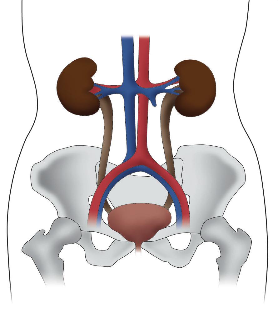 Wat is een urostoma? Een urostoma is een chirurgisch aangebrachte opening die zich op de buik bevindt. Na verwijdering van de blaas kan de urine via deze opening uit het lichaam stromen.