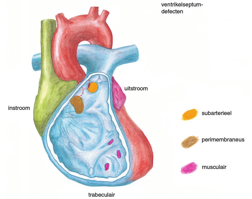.3 Klinisch beeld 5. Figuur.1 Lokalisaties van ventrikelseptumdefecten.. Figuur.2 Schematische weergave van het mechanisme van progressieve sluiting van een membraneus VSD als gevolg van uitzakking van een cusp van de aortaklep (aortaklepprolaps).