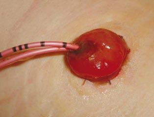 Dit korte segment van de dunne darm wordt als buis of omleiding gebruikt om de urine uit het lichaam te voeren.