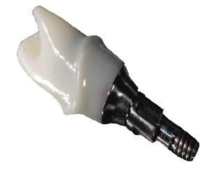 Individueel zirkoon abutment verlijmd op titaanbasis Alphalink Implant 2 x