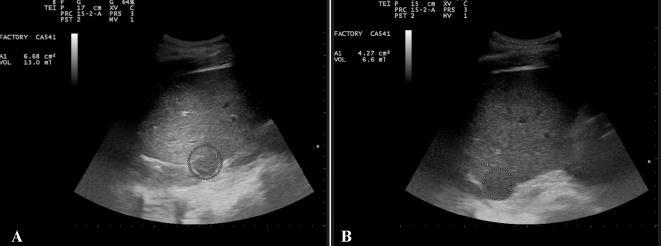 Anti-tumor activiteit van MF eiwit met n-9 vetzuur Dieet: laag koolhydraat (2%) en hoog eiwit heeft