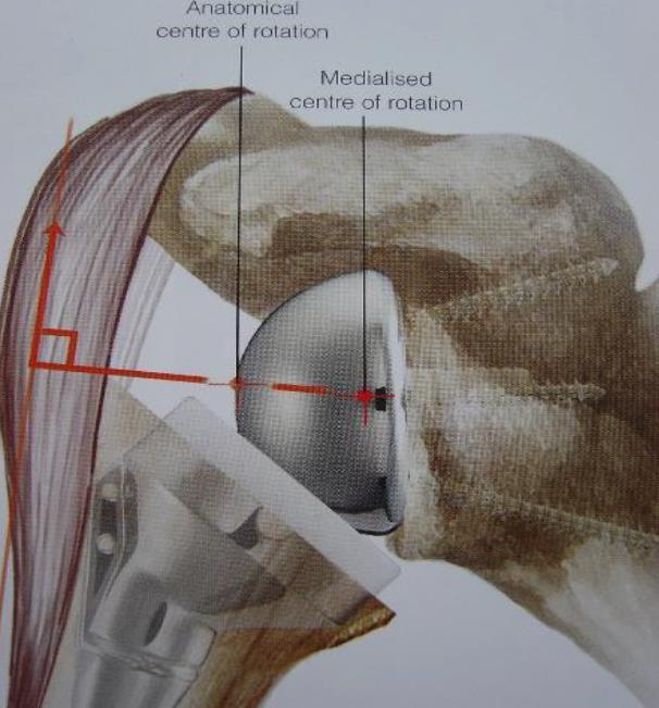 Veranderde biomechanica en de