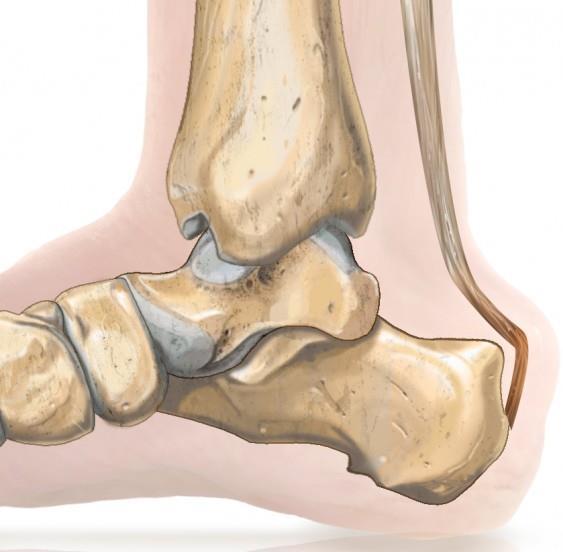 ACHILLESPEES INSERTIE TENDINOPATHIE Haglundse exostose