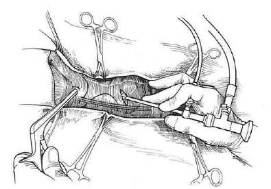 Voor een tenoscopie van de sesamschede wordt het paard in algemene anesthesie gebracht en ofwel in laterale ofwel in dorsale positie gelegd.