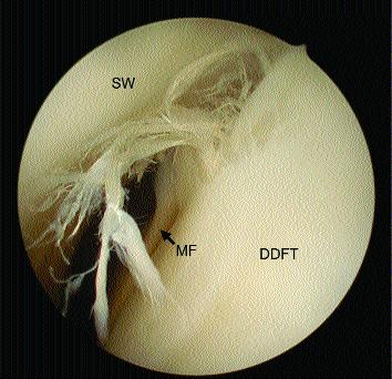 Vervolgens wordt 1cm distaal van de sesambeentjes en 1cm palmair/plantair ten opzichte van de neurovasculaire bundel een incisie gemaakt, die verder als intredepoort voor de endoscoop dient.