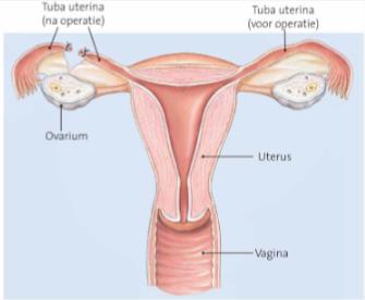 de anticonceptiepil Vaginale barrièremiddelen (pessarium) (95% veilig) Spiraaltje (95% veilig): stimuleert prostaglandines in baarmoeder en remt innesteling Condoom (90% veilig) Periodieke onthouding