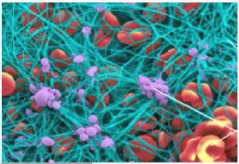 Microscopie van een bloedklonter: Groene dragen: fibrine (eiwit, voorloper van fibrinogeen) Rode cellen : erythrocyten Paarse vlekken: trombocyten Een arteriële bloeding (bloeding in slagaders)