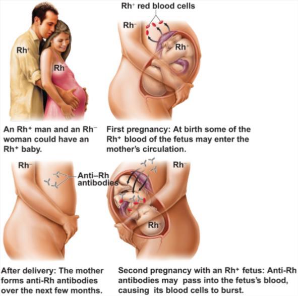 Dit is belangrijk voor de zwangerschap. Bij de geboorte is er uitwisseling tussen het bloed van de moeder en het bloed van het kind. Stel dat de moeder Rh- is en het kind Rh+.