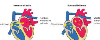 Wat zijn de klachten? Tijdens het boezemfibrilleren kloppen de kamers onregelmatig en meestal ook te snel. Bij sommige mensen wordt het boezemfibrilleren bij toeval ontdekt.