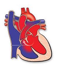 Aangeboren hartafwijkingen ventrikelseptumdefect 42% atriumseptumdefect 9%