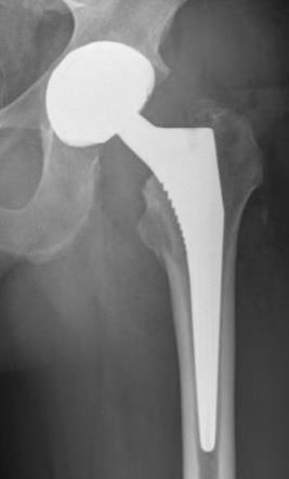 Vergeet de aanvraag voor de radiografie niet die u bij ontslag meegekregen heeft. Een tweede controle 3 maanden na de operatie is enkel aangewezen bij problemen met de revalidatie of na een revisie.