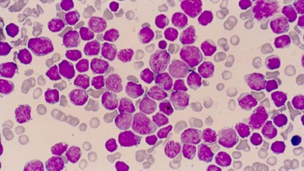Acute leukemie Acute leukemie: Blok in differentiatie (cellen verliezen vermogen om zich te ontwikkelen tot rijpe functionerende cellen) [hierdoor