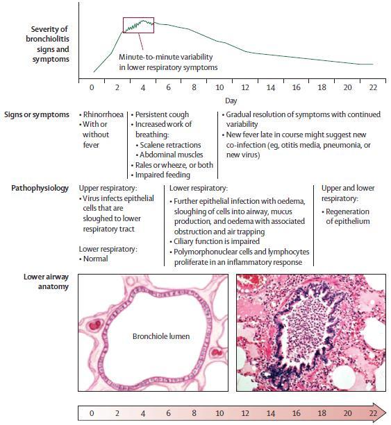 Symptomen bronchiolitis Apneus 40 % > 14 dagen