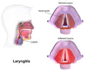 Laryngitis subglottica Pseudokroep Engels: croup Virale hoge