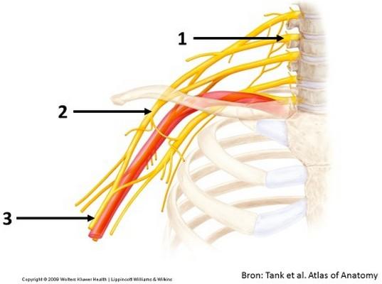 pagina 12 van 27 Welke structuren worden met de nummers aangeduid? 1 medius 2 medius 3 medius (i) C5 (ii) C6 (iii) fasciculus lateralis (iv) fasciculus medialis (v) n. medianus (vi) n.