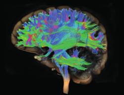 DTI imaging maakt alle zenuwbanen zichtbaar. De communicatie-routes van het brein Het is ook mogelijk om alleen de zenuwbanen in beeld te brengen met DTI: diffusietensor imaging.