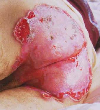 Extensive Herpes genitalis