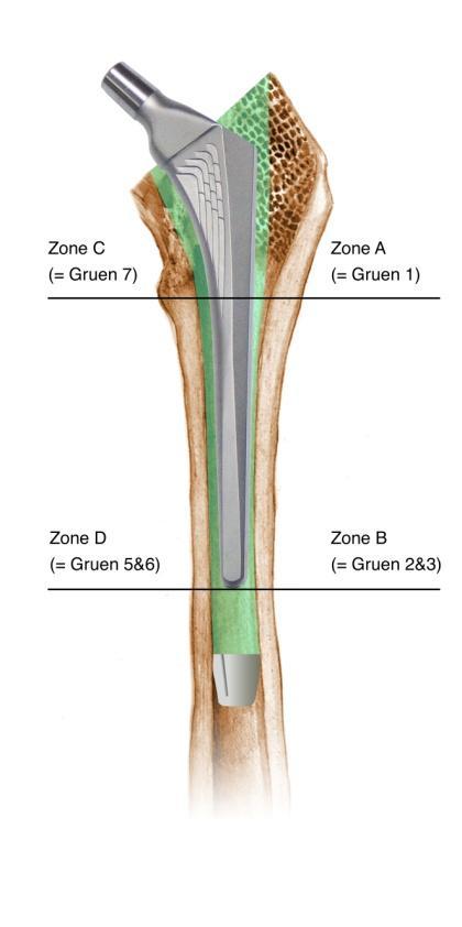 Scientific Hip Prosthesis vs.