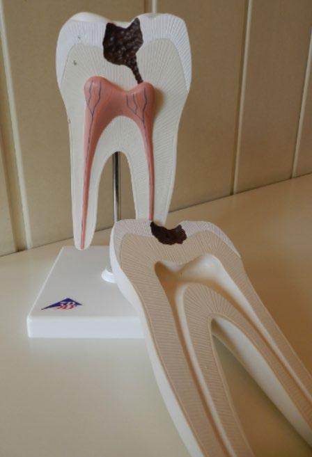 HANDLEIDING TANDENKOFFER Model van een tand met gaatje Op dit model zie je hoe een gaatje eruitziet wanneer dit reeds langere tijd aanwezig is.
