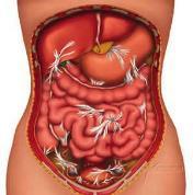 Laparoscopie colorectaal carcinoom (CRC) Voordelen van laparoscopie Sneller postoperatief herstel 1