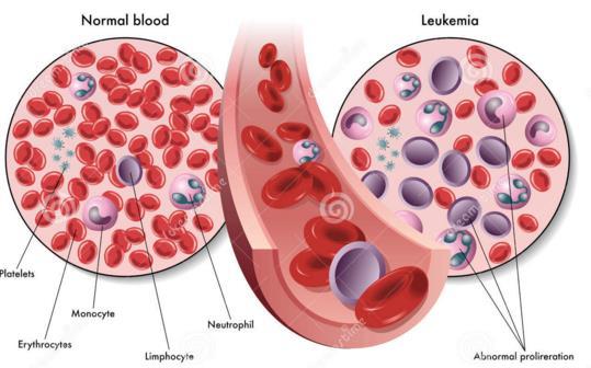 2. Inleiding 2.1 Algemene pathogenese en indeling Leukemie is een maligne aandoening van het beenmerg en bloed en wordt gekenmerkt door defecten in de progenitor of voorloper cellen (1).