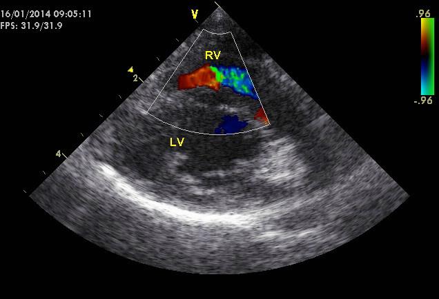 Figuur 2: Kleuren Doppler ter hoogte van het rechter ventrikel, vanuit een rechter parasternale dwarse doorsnede ter hoogte van de hartbasis.
