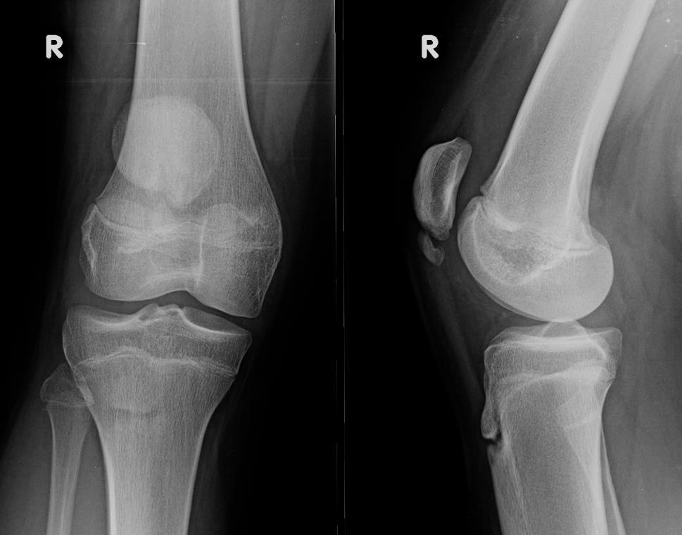 Niet acute knie radiografie: trauma