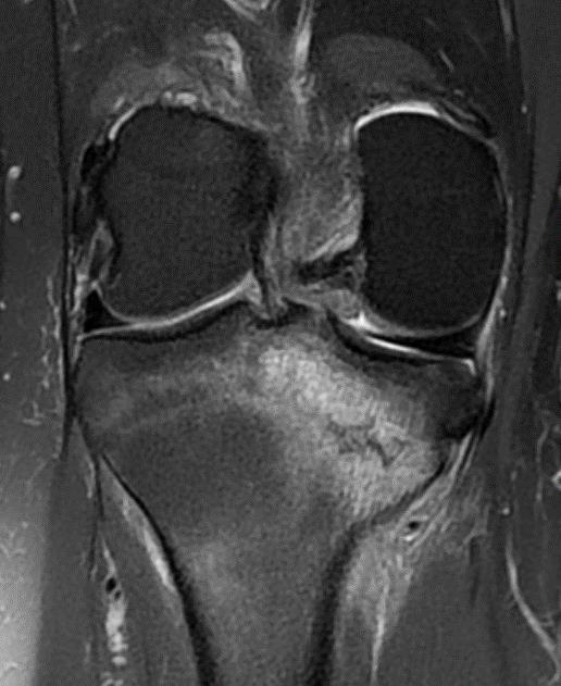 Niet acute knie MRI: Voordelen evaluatie van verschillende elementen in 1 hoge