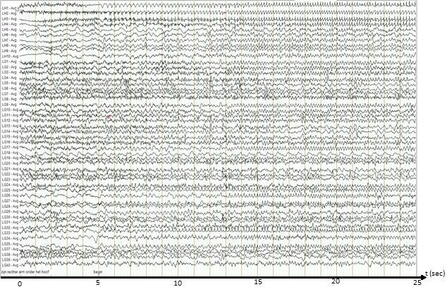 Figuur 2: EEG verloop In deze figuur wordt op de x-as het tijdsverloop weergegeven. De x-as is verdeelt in 1 seconde intervallen (iedere licht bruin-oranje gekleurde lijn stelt 1 seconde voor).