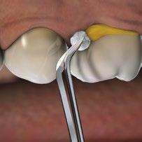 Chirurgische ingreep Als de parodontitis vergevorderd is, kan een chirurgische ingreep noodzakelijk zijn.