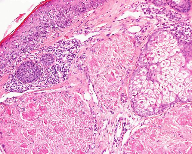 epidermis collageen haarfollikel amyloïddeposities talgklier a b Bij de gelokaliseerde cutane amyloïdose kan op beperkte schaal behandeling geboden worden, met wisselend succes.