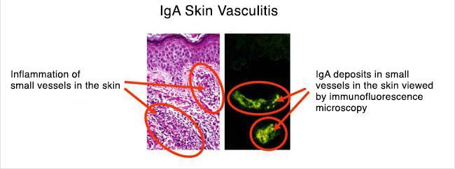 HSP = IgA Vasculitis