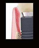 II. NAMIDDAGSESSIES 2019 Namiddagsessies 1 & 8 Peri-implantitis: Vermijden als beste therapie en hoe aan te pakken? Wat kan de chirurg alvast doen? Wat kan de tandarts alvast doen?