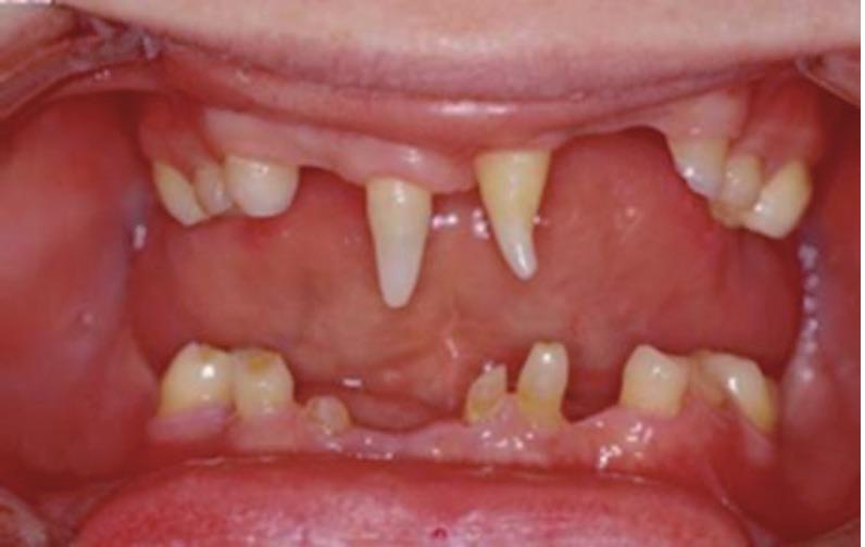 Naarmate meer tanden ontbreken, komen daar ook functionele problemen bij.