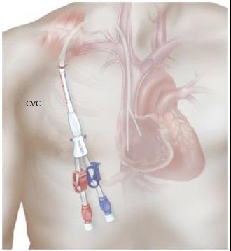 Centraal veneuze katheter Een centraal veneuze katheter wordt ingebracht in een bloedvat ter hoogte van het