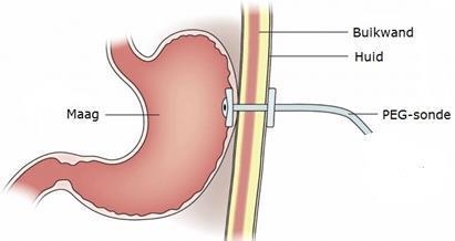 Deze wordt geplaatst wanneer sondevoeding langdurig toegediend wordt (>4-6 weken).