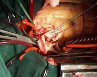 pacemakerleads Epicardiale implantaties 6-8