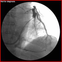 Ventriculaire dys/asynchronie, QRS > 130 ms LBBB Endovasculaire plaatsing LV-electrode Epicardiale LV-electrode